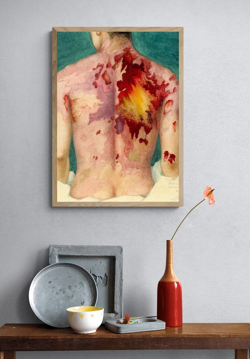 Watercolor painting mustard gas burns. — room view 3