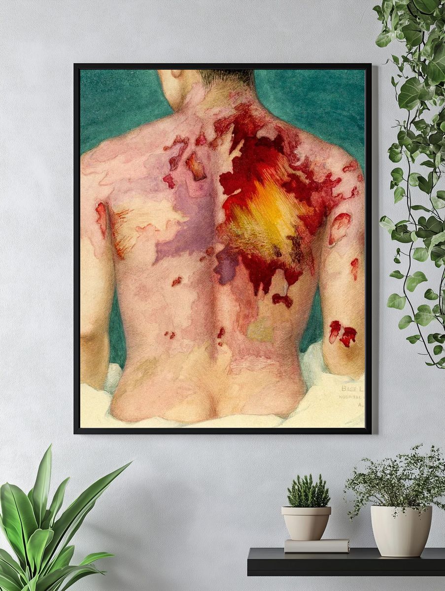 Watercolor painting mustard gas burns. — room view 4