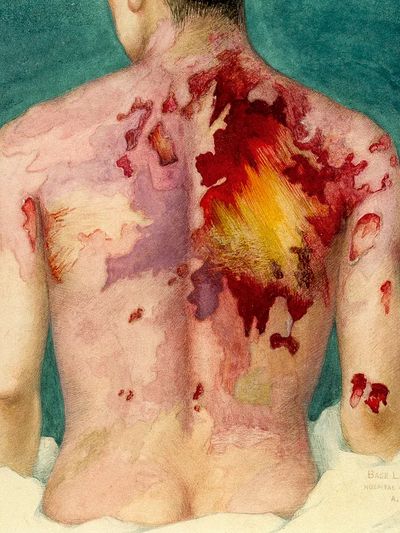 Watercolor painting mustard gas burns.
