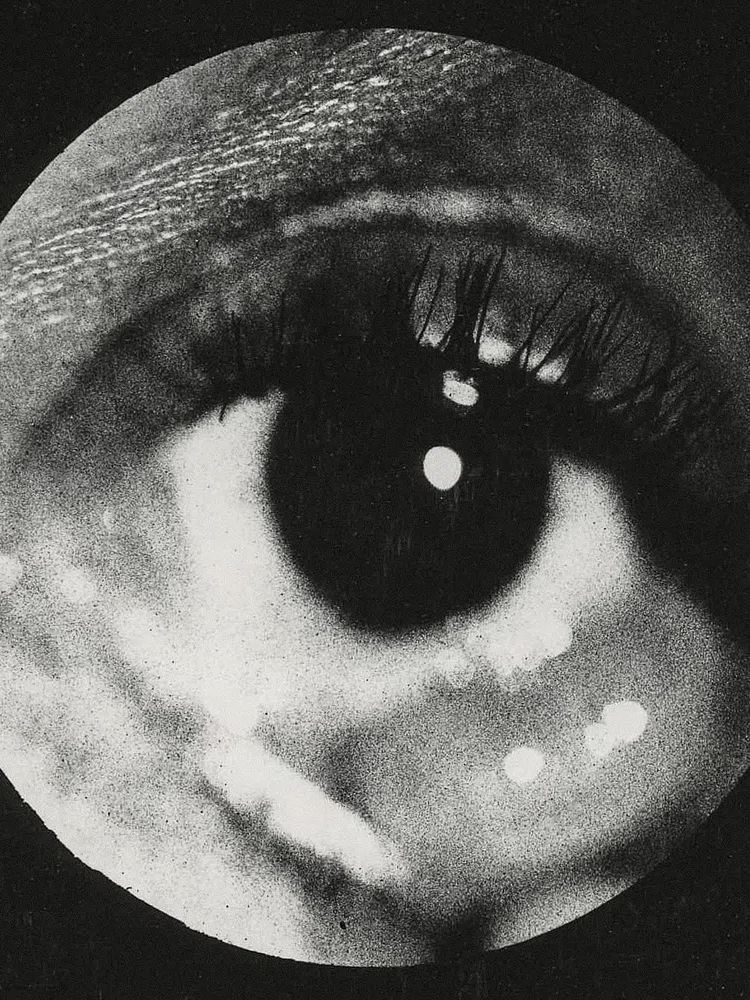 Clinical photograph cyst conjunctiva. Original. poster detail