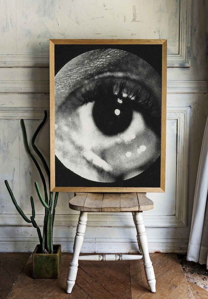 Clinical photograph cyst conjunctiva. Original. — room view 1