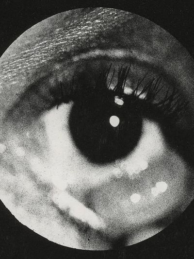 Clinical photograph cyst conjunctiva. Original. poster print