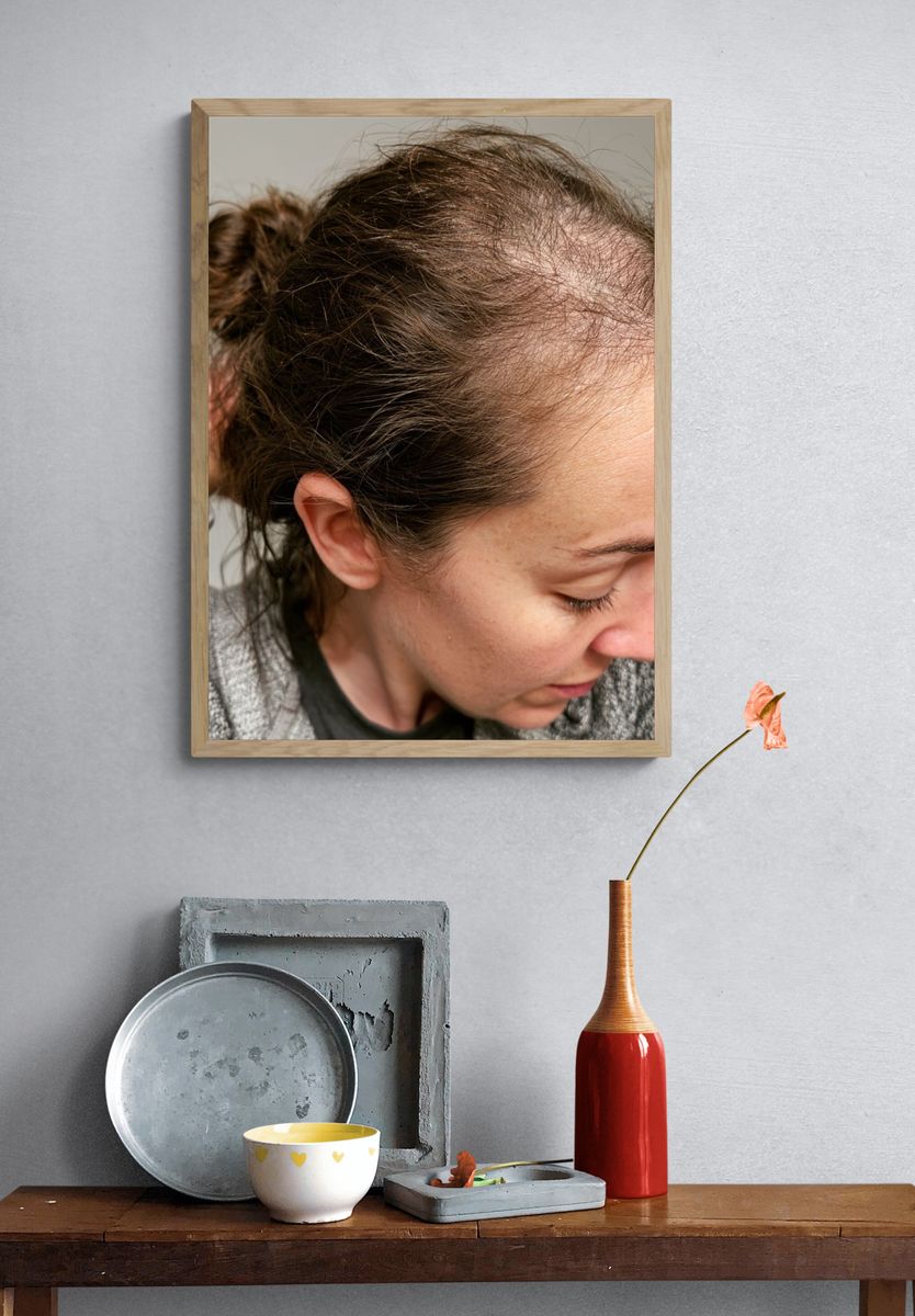 Hair Loss Portrait Photography Poster. — room view 3