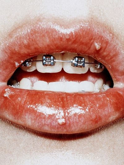 Braces Lips Close-Up Photography Poster.