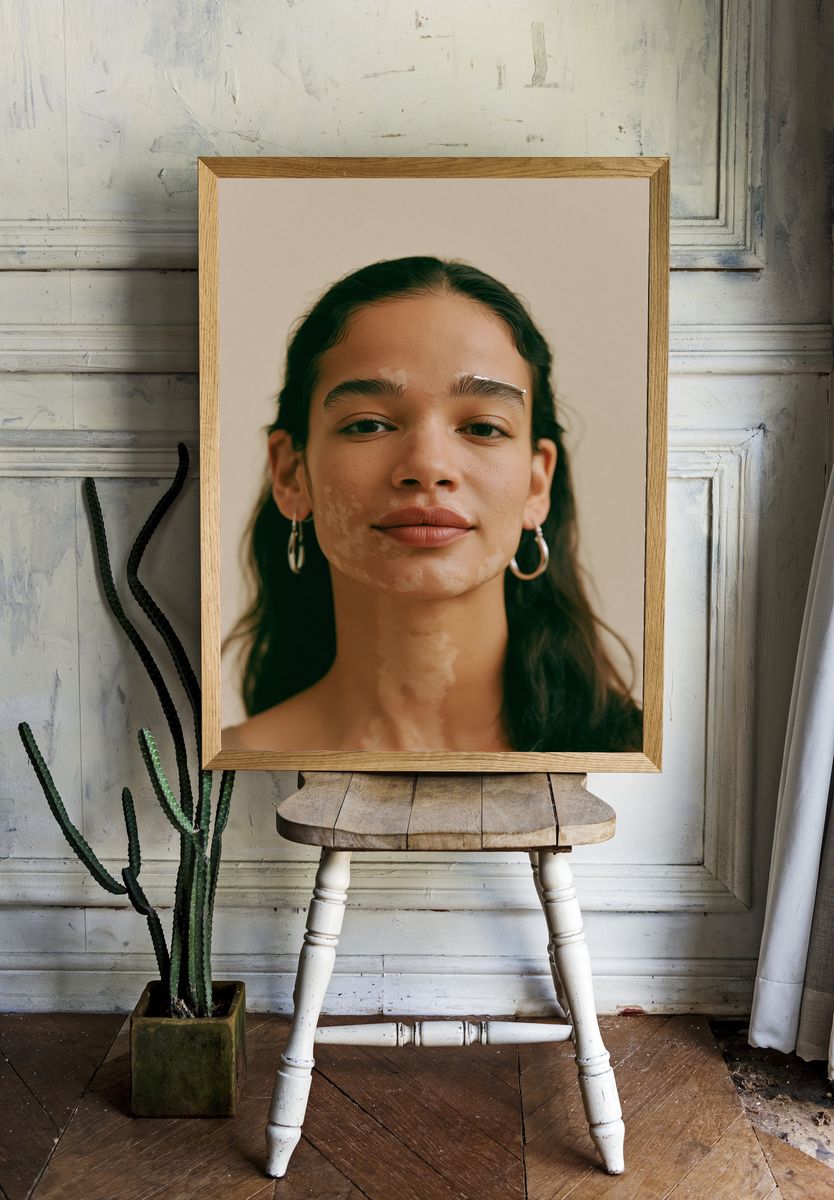 Portrait with Vitiligo Photography Poster. room preview