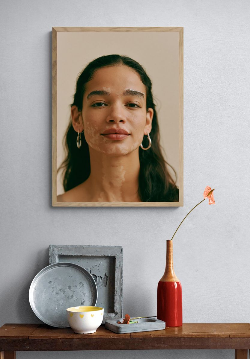 Portrait with Vitiligo Photography Poster. — room view 3