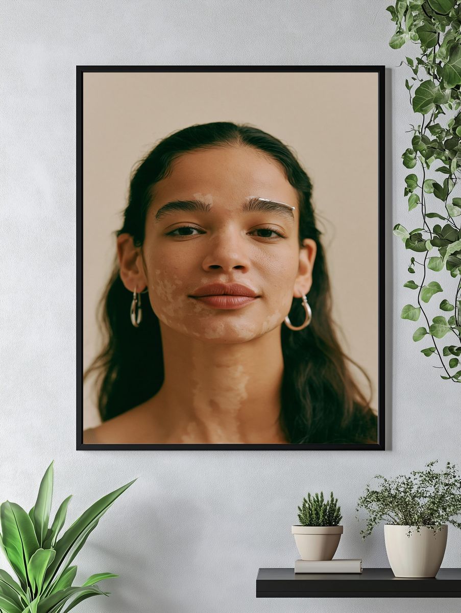 Portrait with Vitiligo Photography Poster. — room view 4