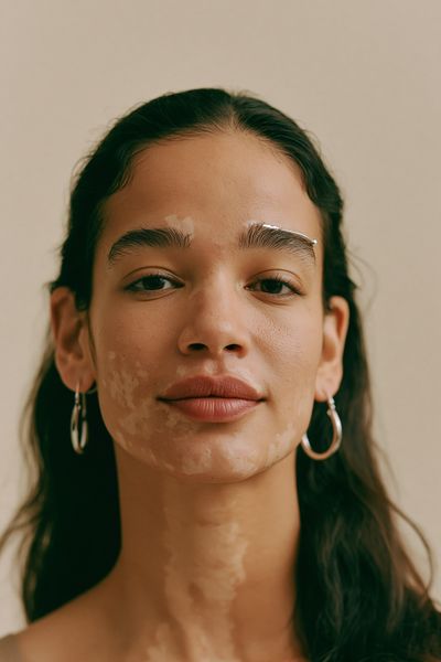 Portrait with Vitiligo Photography Poster. poster
